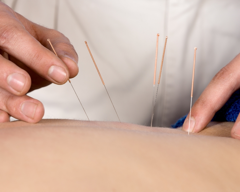 Acupuncture Singapore